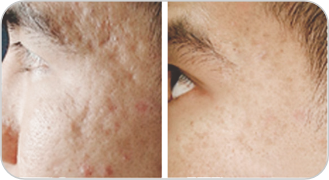 Before and After1 Avant et Après1