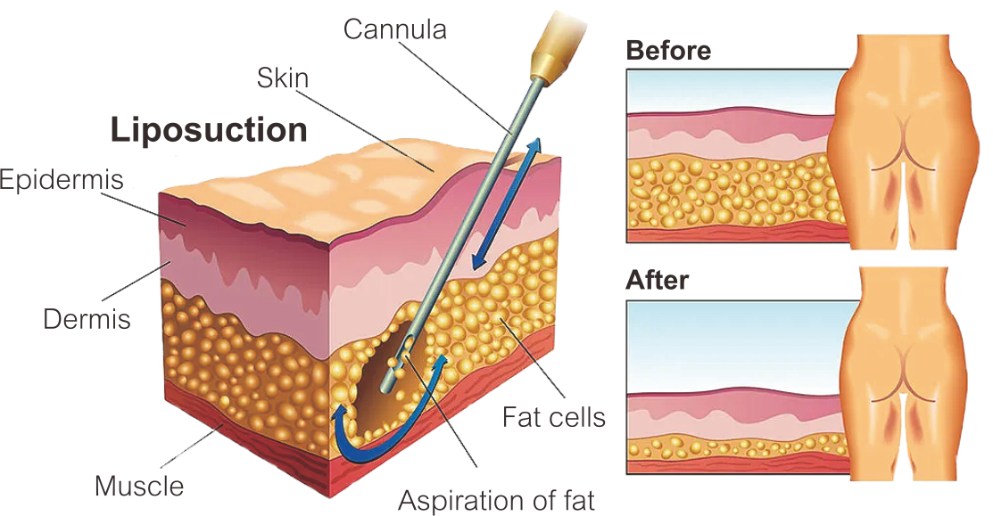 Laser Lipolysis Pièce à main de lipolyse laser