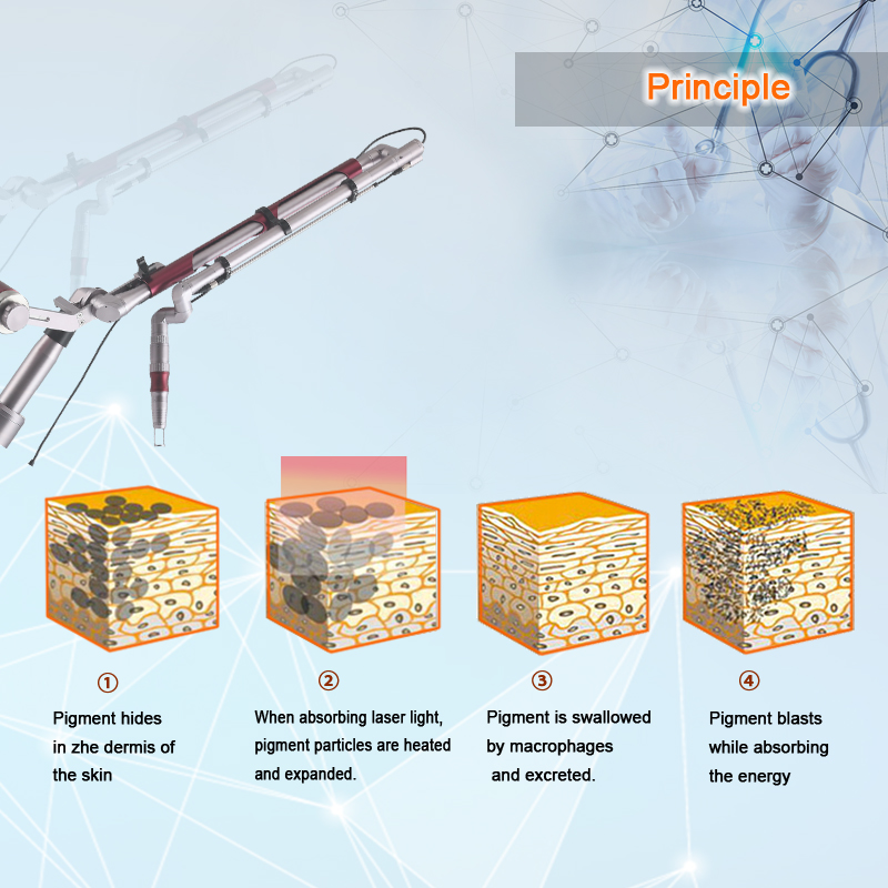 laser tattoo removal equipment équipement de détatouage au laser