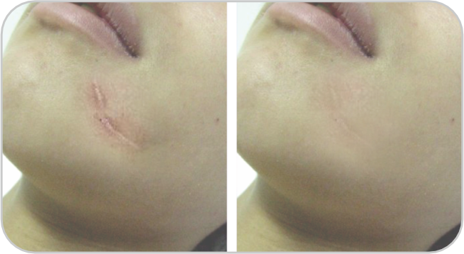 Before and After2 Avant et Après2