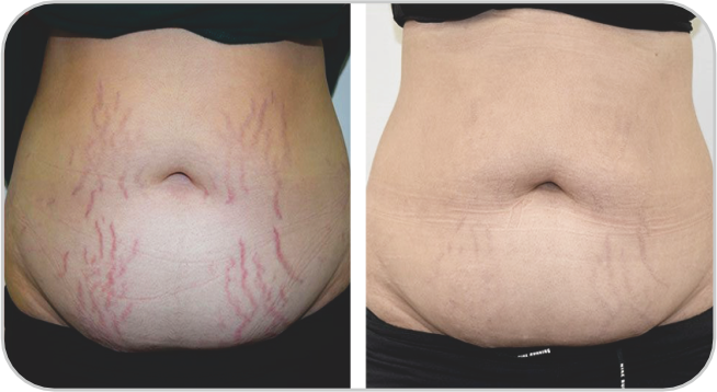 Before and After3 Avant et Après3