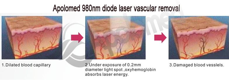 980nm diode laser vascular laser à diode 980nm vasculaire