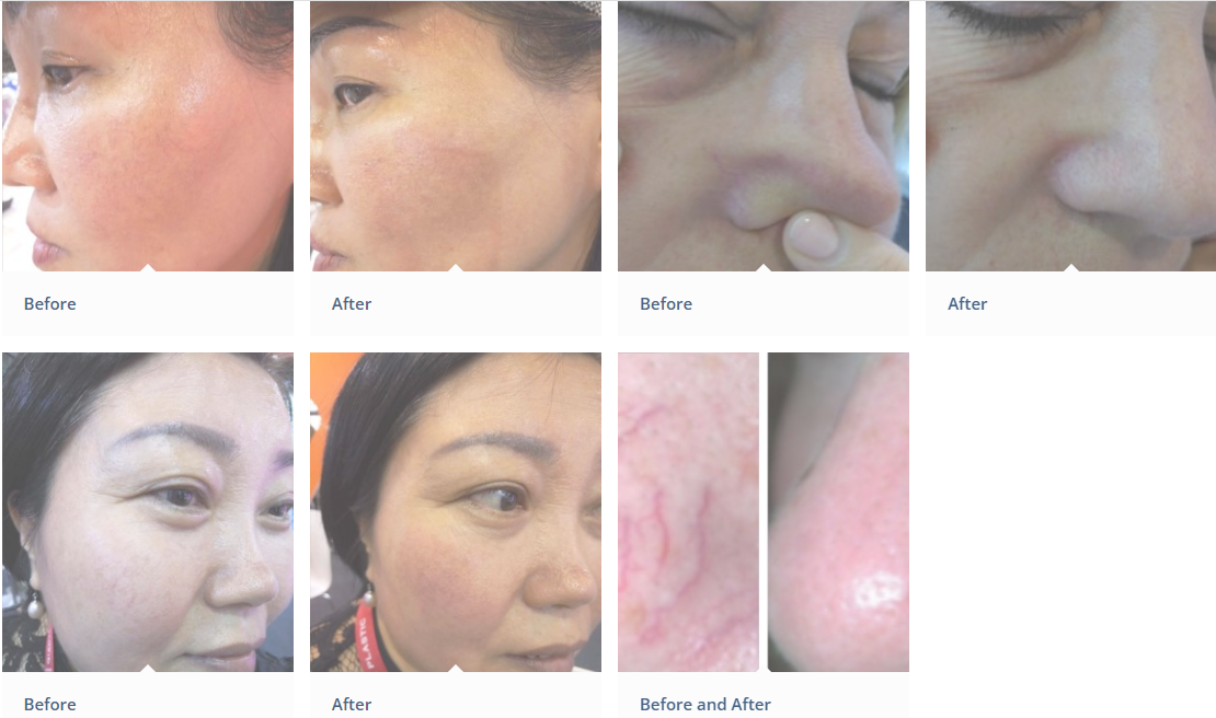 Before after photo Photo avant après