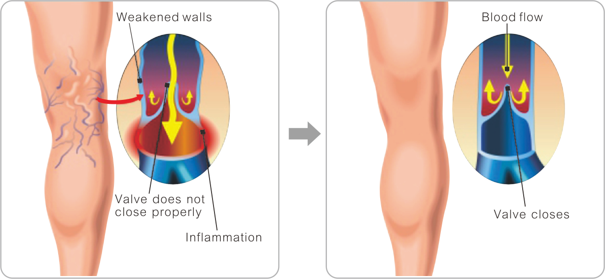Varicose veins Varices