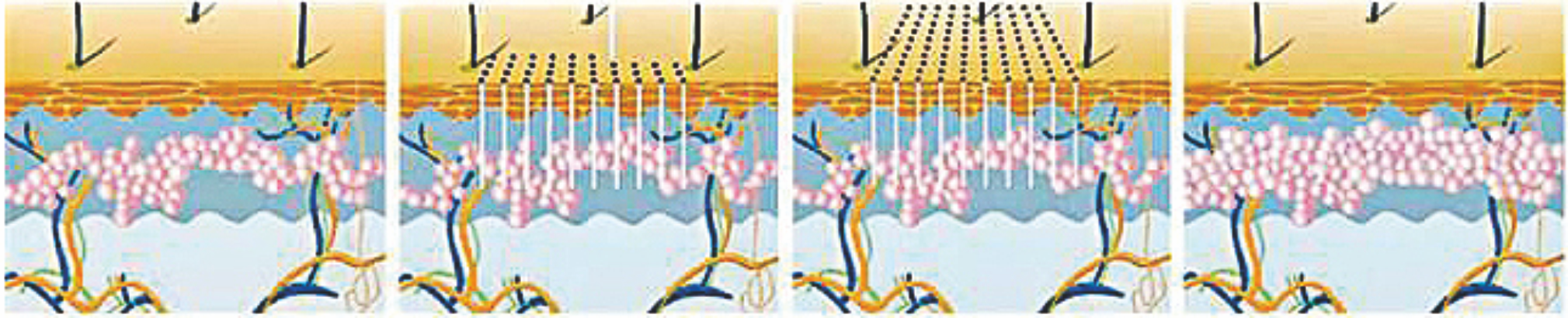 1550nm Erbium Fiber Laser----Deep remodeling Laser à fibre Erbium 1550 nm ---- Remodelage en profondeur