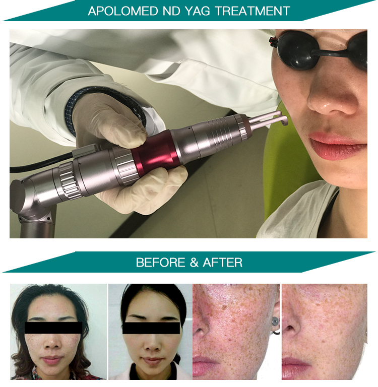 HS-298 photo avant apr&egrave;s