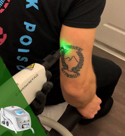 &Eacute;quipement laser QS 2 