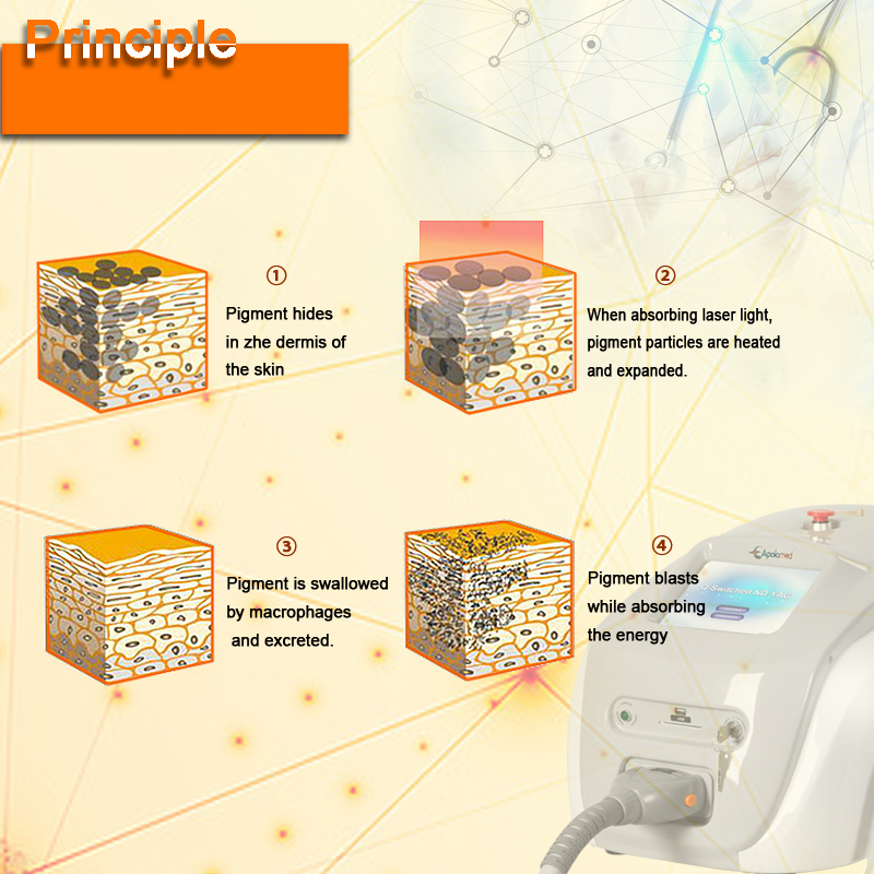 q changer le d&eacute;tatouage 