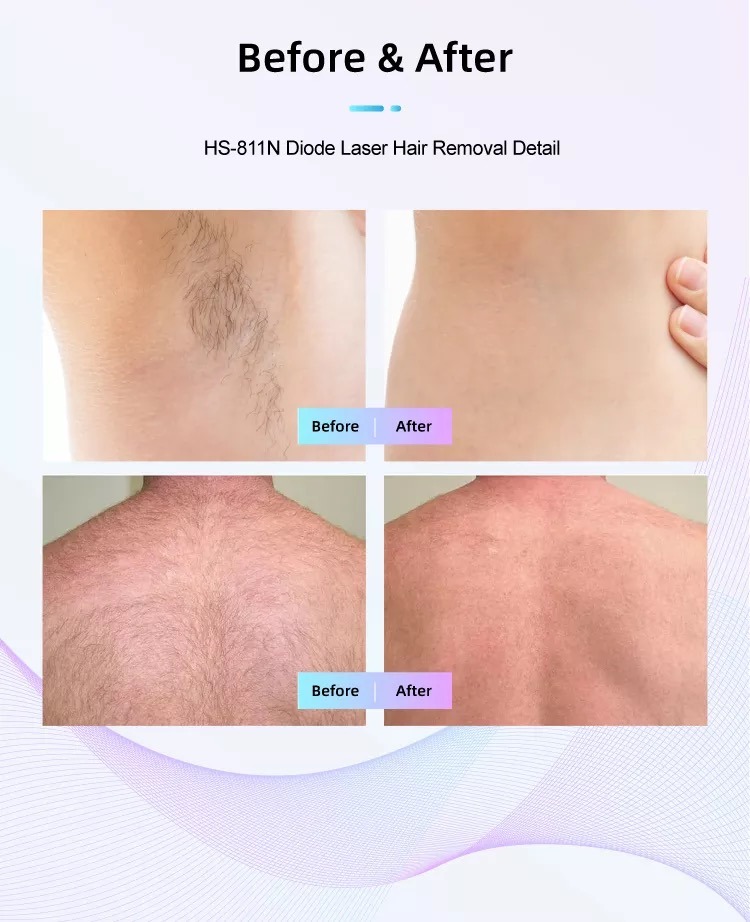 Usine de machine d'&eacute;pilation au laser &agrave; diode HS-811