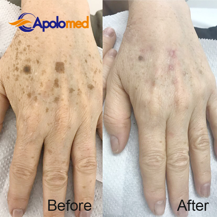 Machine laser Nd YAG Q-Swithced avant apr&egrave;s