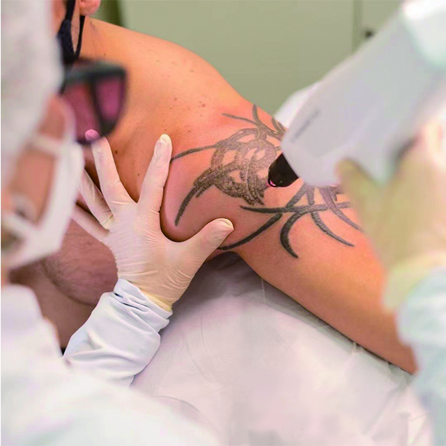 Pourquoi l'élimination du laser de tatouage est-elle si chère?