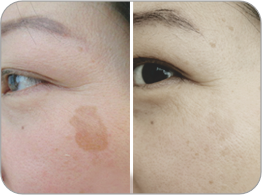 Avant et apr&egrave;s 2