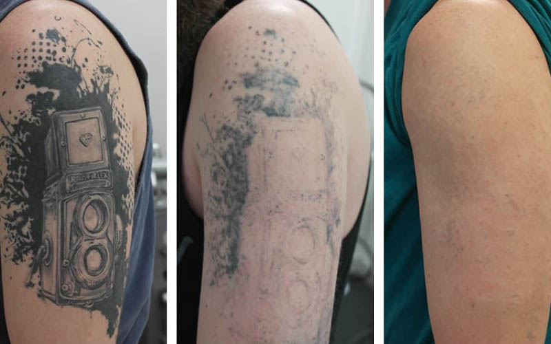 Façons de supprimer les tatouages ​​indésirables du corps